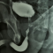Urethral stricture / defect